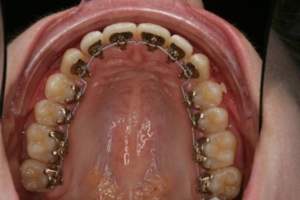 lawaai Pigment Springen Linguale beugel - Orthodontie Hoofddorp